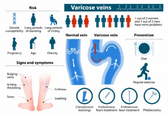 Eziologia vene varicose