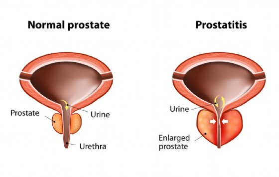 Rappresentazione grafica della prostatite