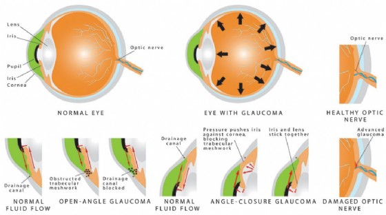 Il glaucoma