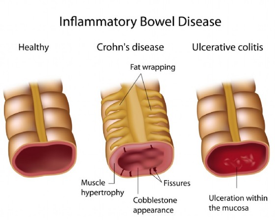 Morbo di Crohn