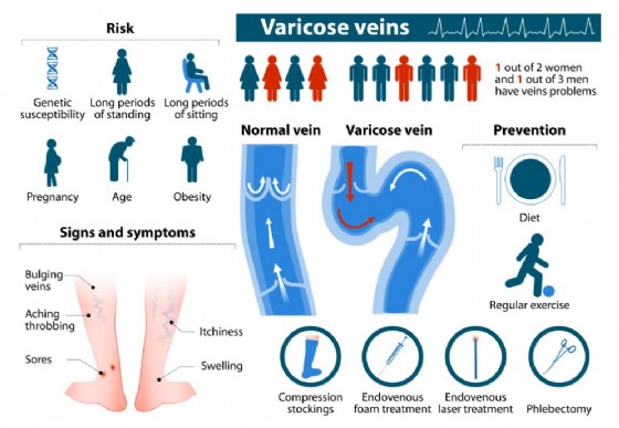 Eziologia delle vene varicose