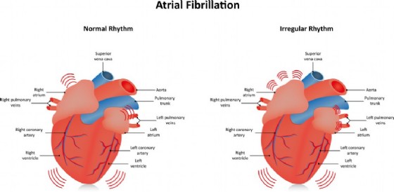 Fibrillazione atriale