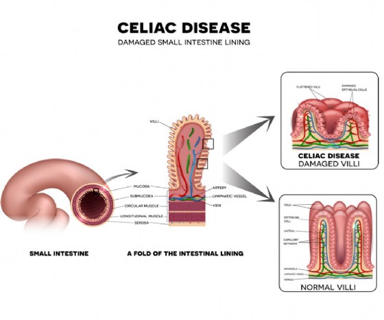 Manifestazione della celiachia a livello intestinale