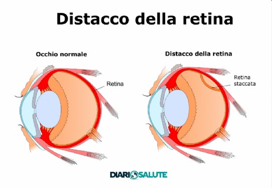 Distacco della retina
