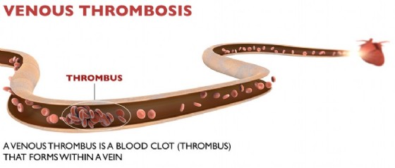 Trombosi