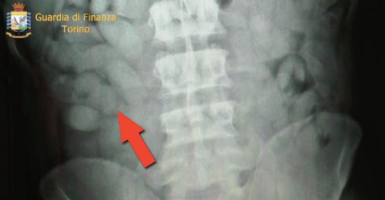 La cocaina nello stomaco