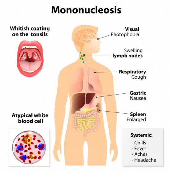 I sintomi della mononucloeosi
