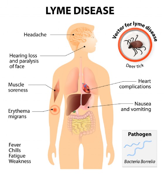 I sintomi della malattia di Lyme