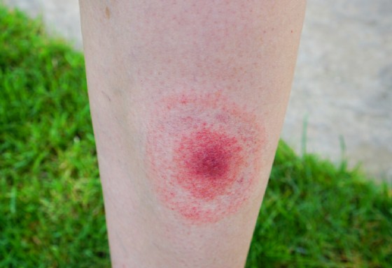 Eritema a bersaglio tipico della malattia di Lyme