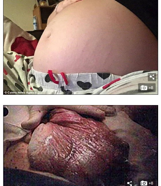 Screenshot dal Daily Mail della pancia e della cisti di Kirsty