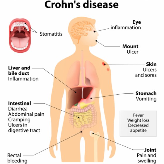 Sintomi del morbo di Crohn