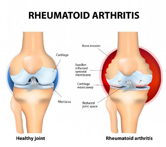 Artrite reumatoide