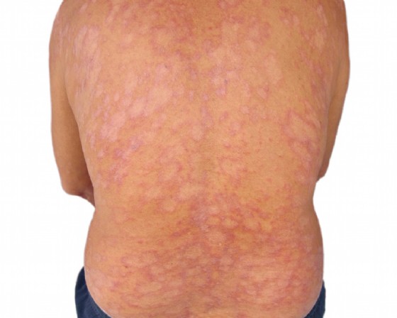 Tinea corporis