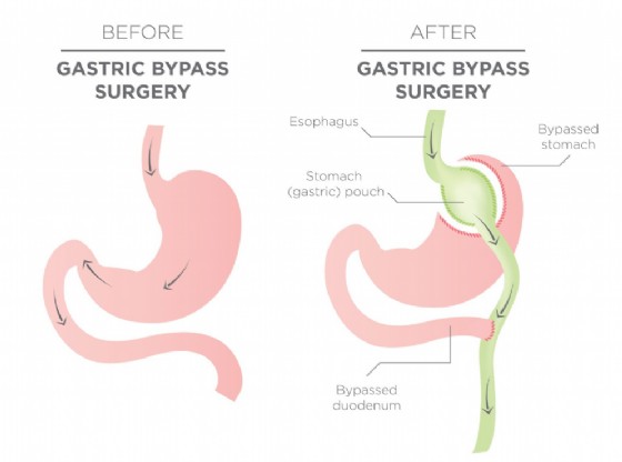 La procedura del bypass gastrico, un intervento di chirurgia bariatrica