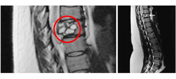 Le larve della tenia nelle vertebre della donna