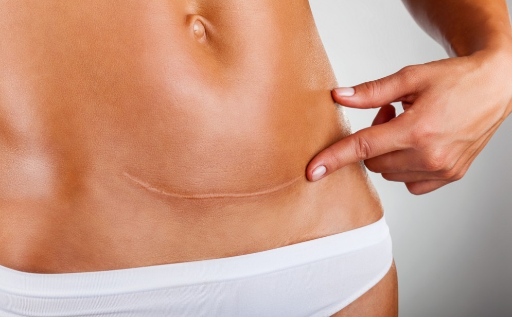 Cancro ovarico, una ragazza lo scopre dopo aver fatto sesso