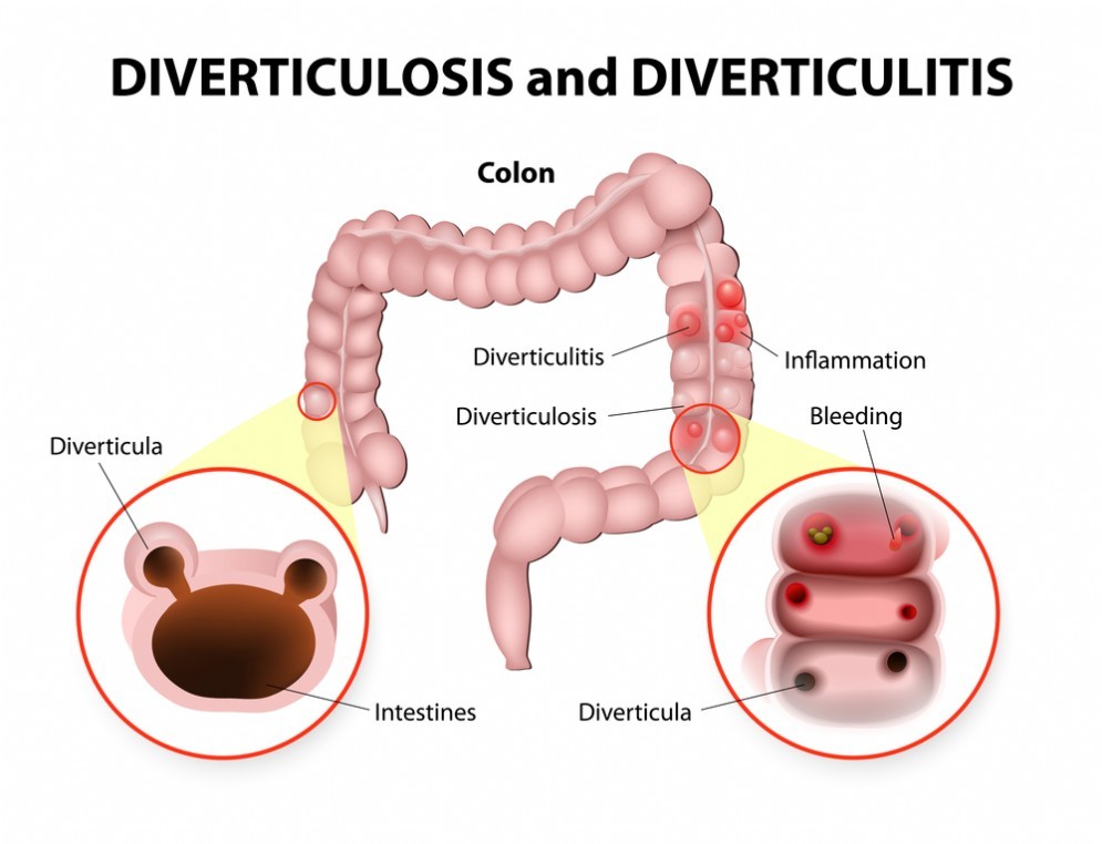 Processo infiammatorio dei diverticoli