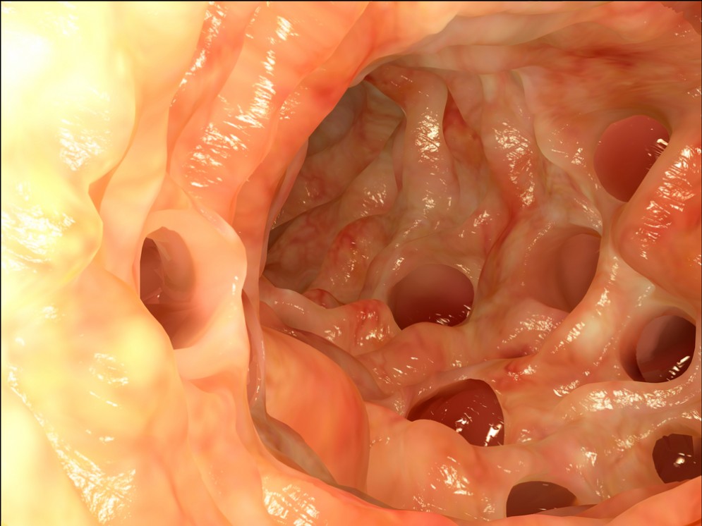Diverticoli