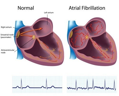 La fibrillazione atriale differenza anatomia ed ECG