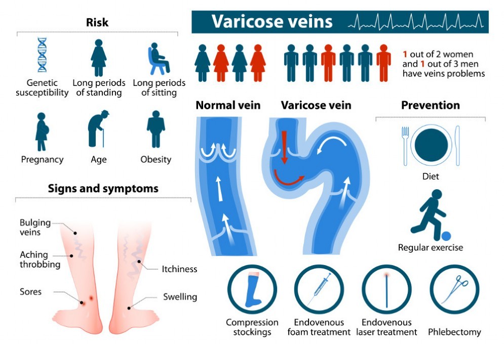 Eziologia delle vene varicose