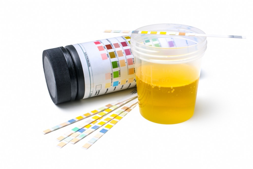 Esame delle urine