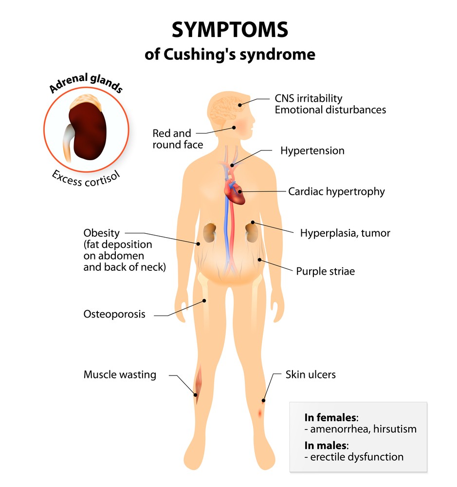 Sindrome di Cushing