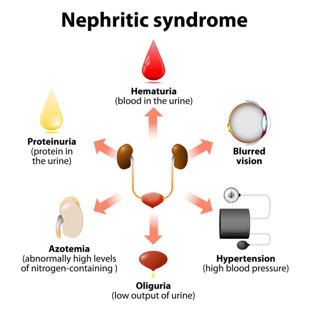 Sindrome Nefritica
