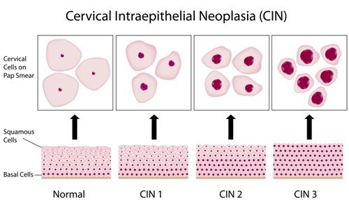 I vari stadi di cancro al collo dell'utero