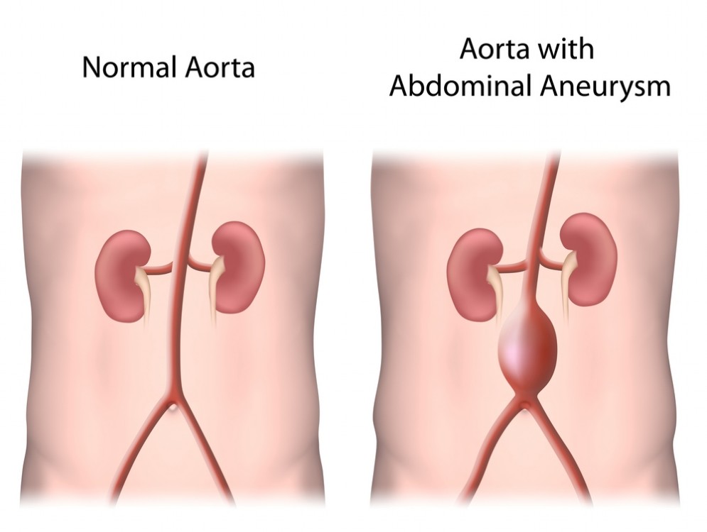 Aneurisma dell'aorta addominale