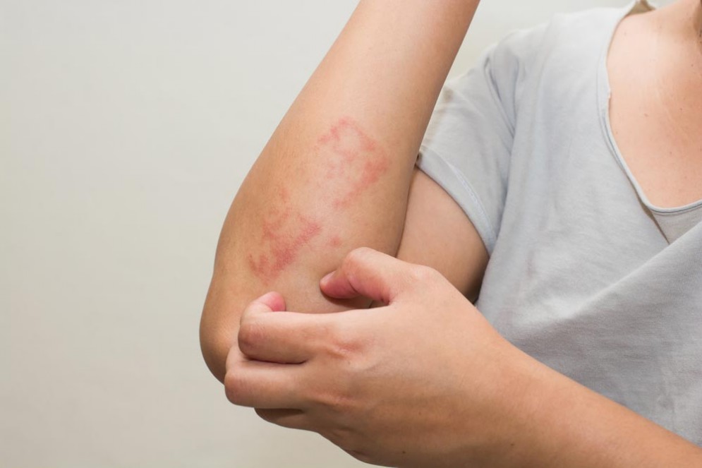 La psoriasi abbassa la qualità della vita