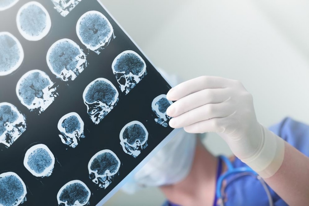 Ictus, aprile è il mese della prevenzione