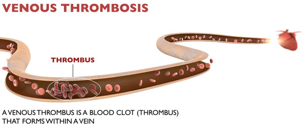 Trombosi