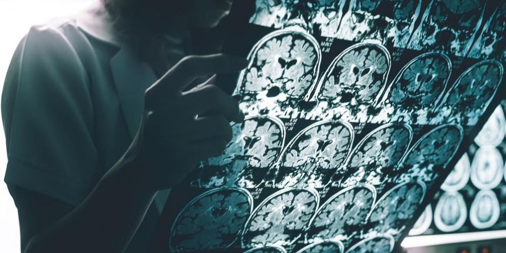Malattia di Alzheimer nel cervello