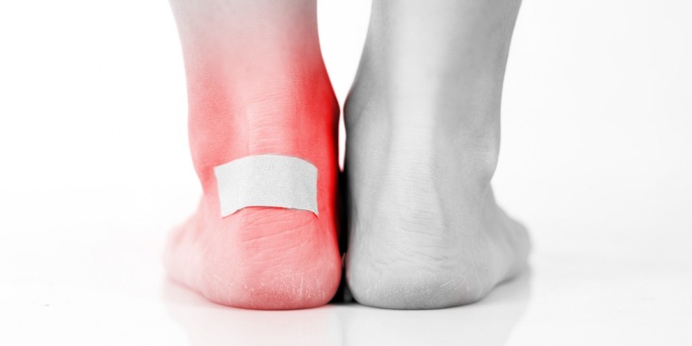 I rimedi naturali per le vesciche ai piedi
