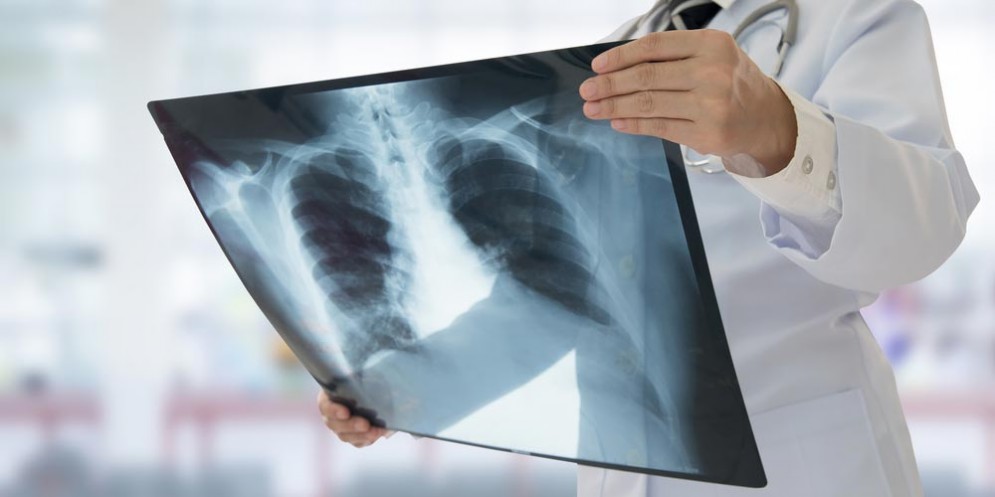 Tubercolosi, una donna la contrae mentre fa pulizia in ospedale