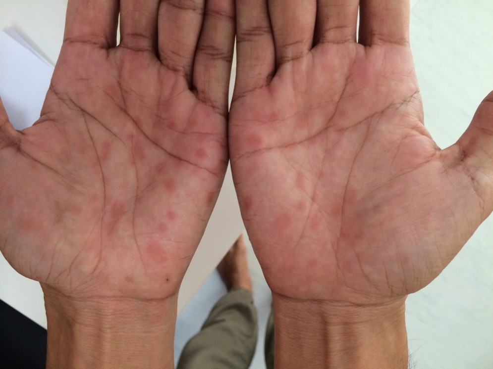 Sifilide nel palmo della mano