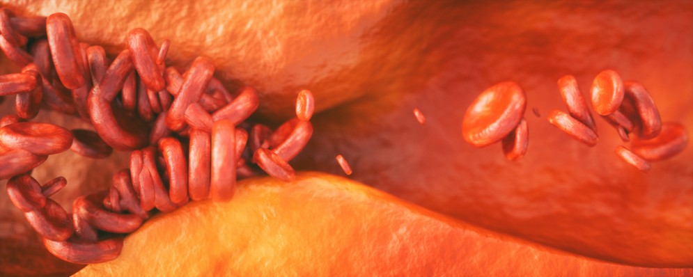 Il farmaco che scioglie le placche nelle arterie