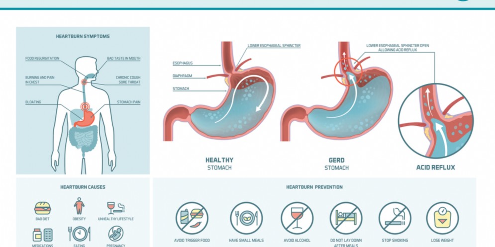 Sintomi e cause del reflusso gastroesofageo