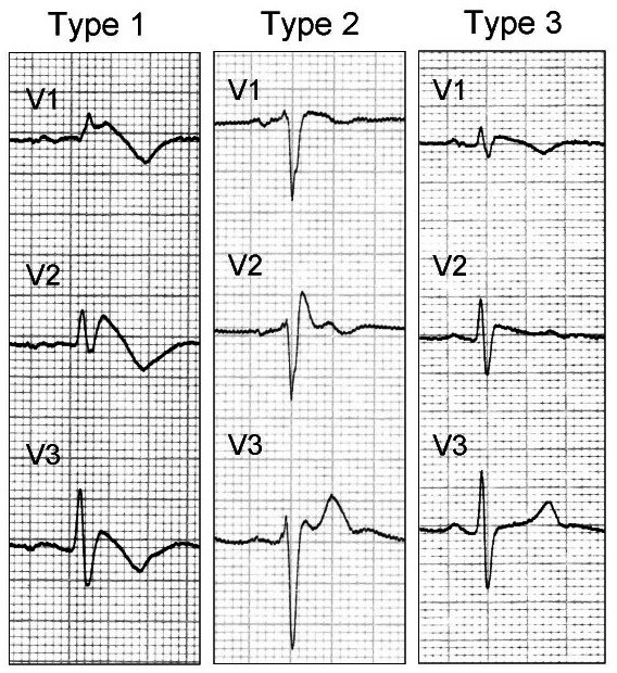 Pattern elettrocardiografico in paziente con sindrome di Brugada