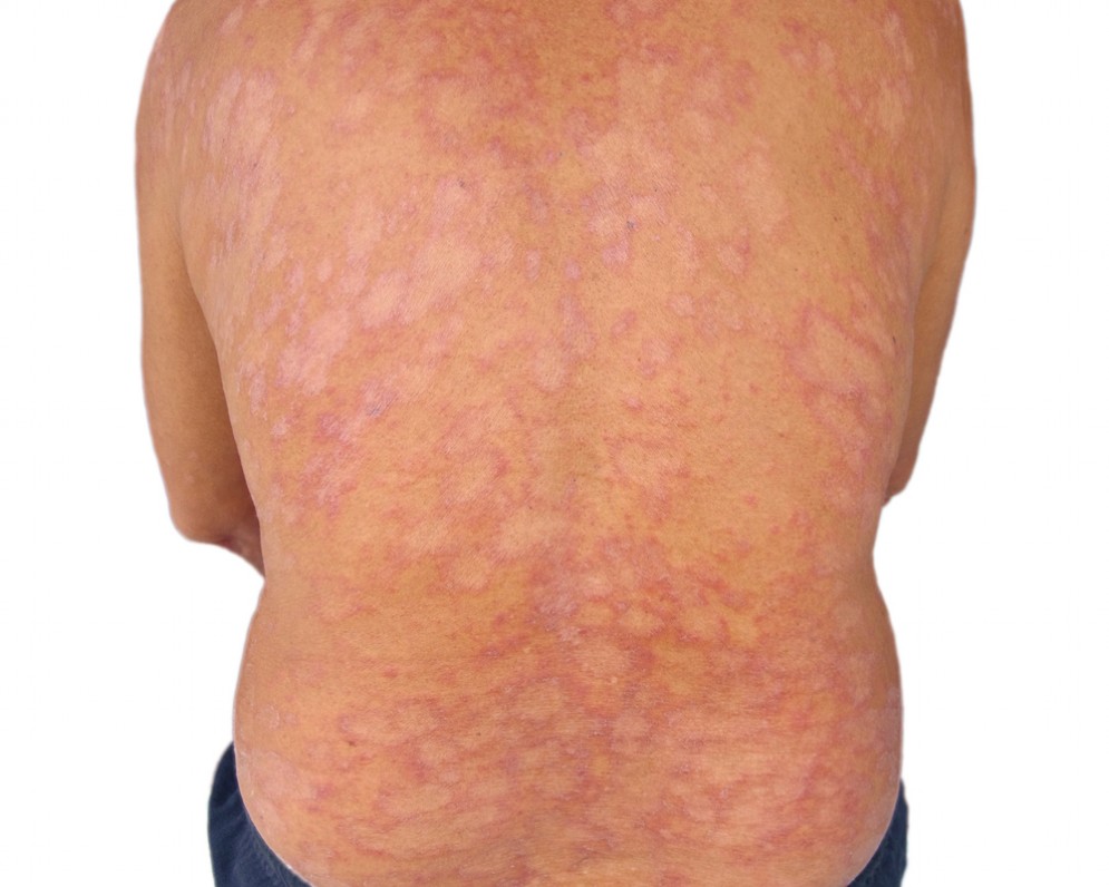 Tinea corporis