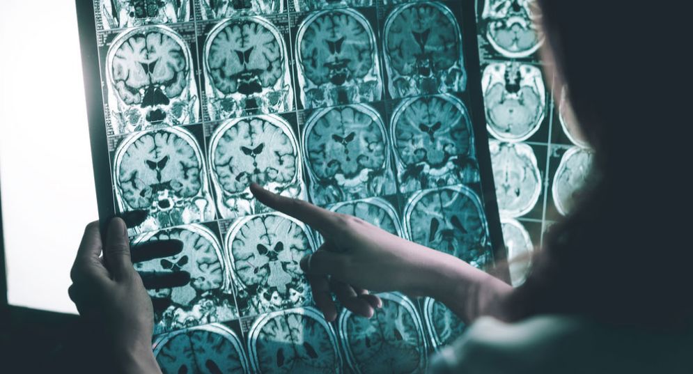 Alzheimer