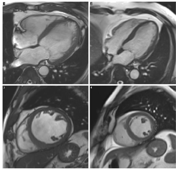 Questa immagine mostra una sezione trasversale della lunghezza di un cuore con cardiomiopatia alcolica. La dimensione complessiva del cuore è ingrandita