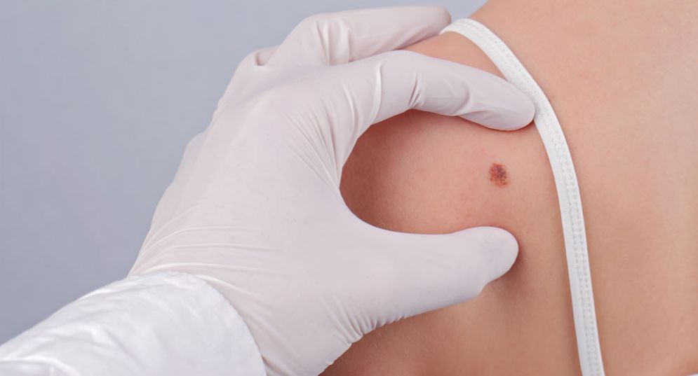 Melanoma