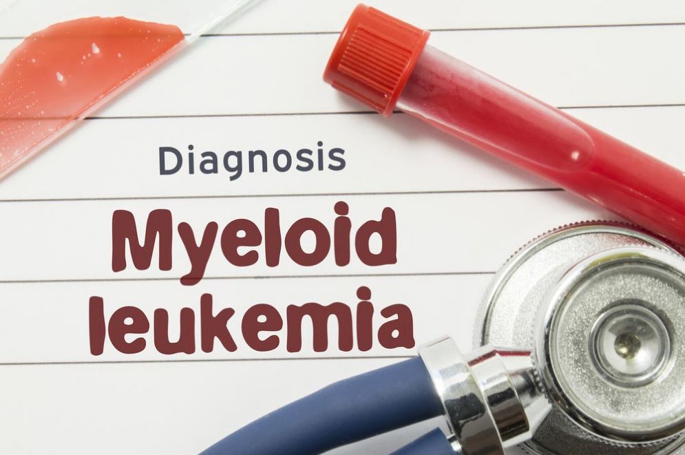 Leucemia mieloide acuta