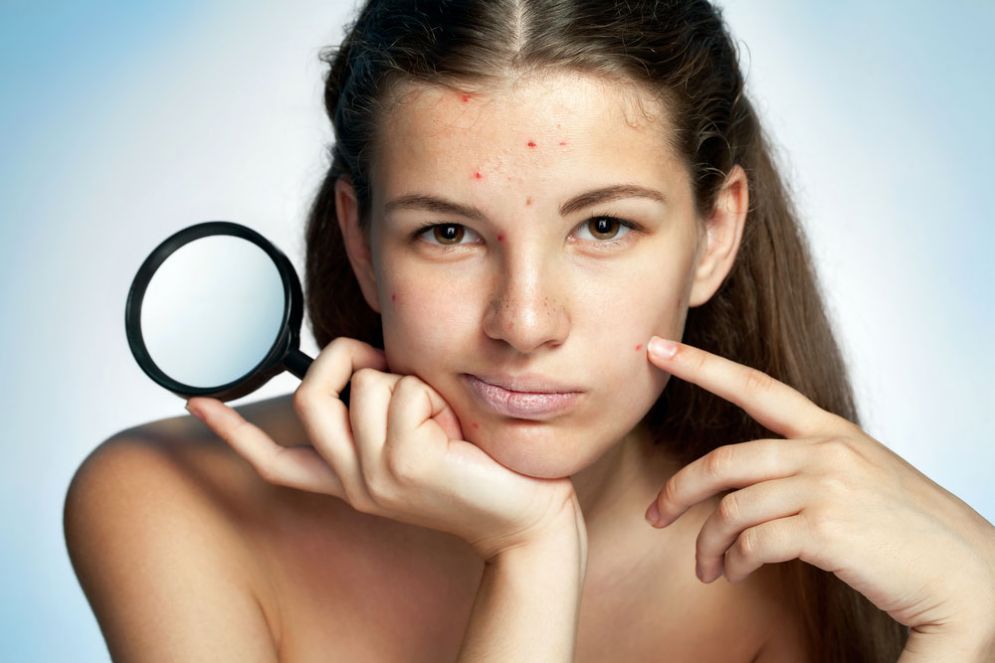Acne nelle donne
