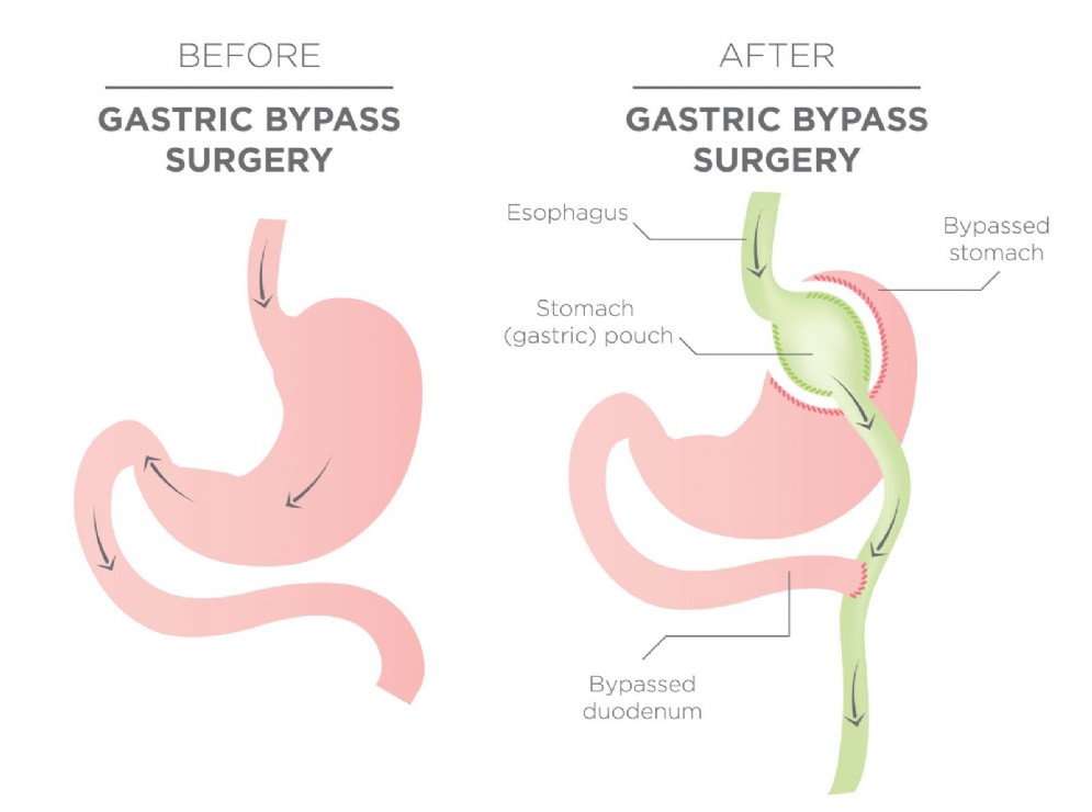 La procedura del bypass gastrico, un intervento di chirurgia bariatrica