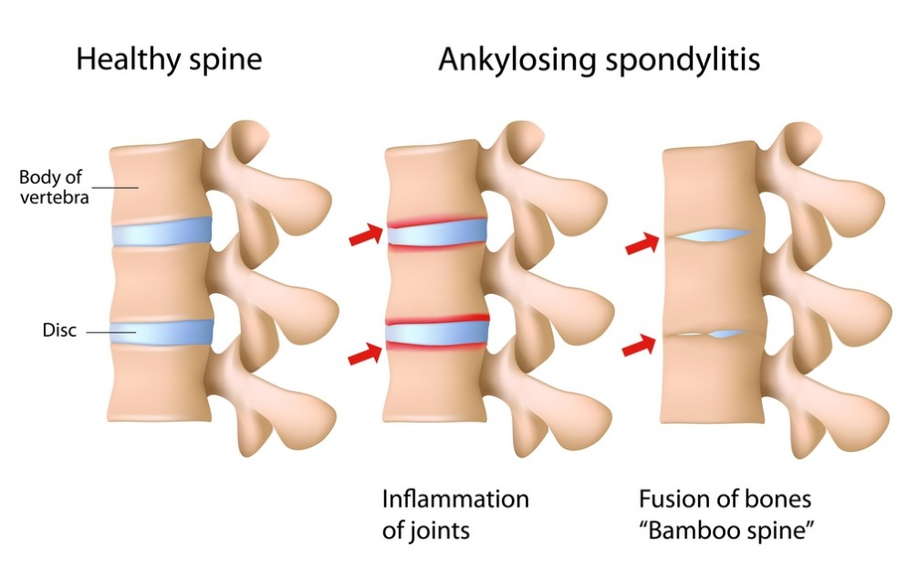 Spondilite anchilosante