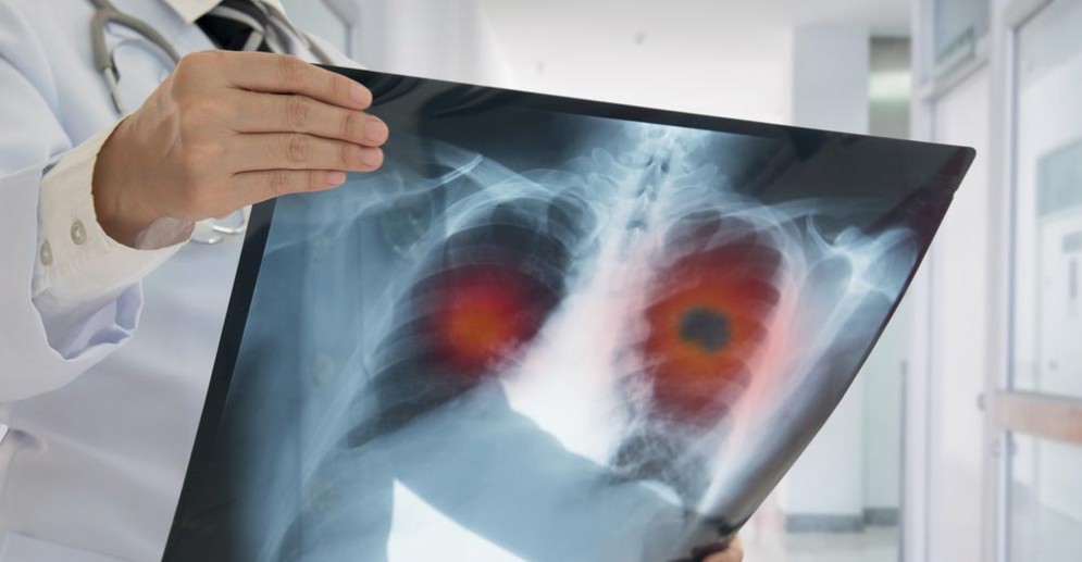 Il cancro esisteva gi nell'antico egitto?