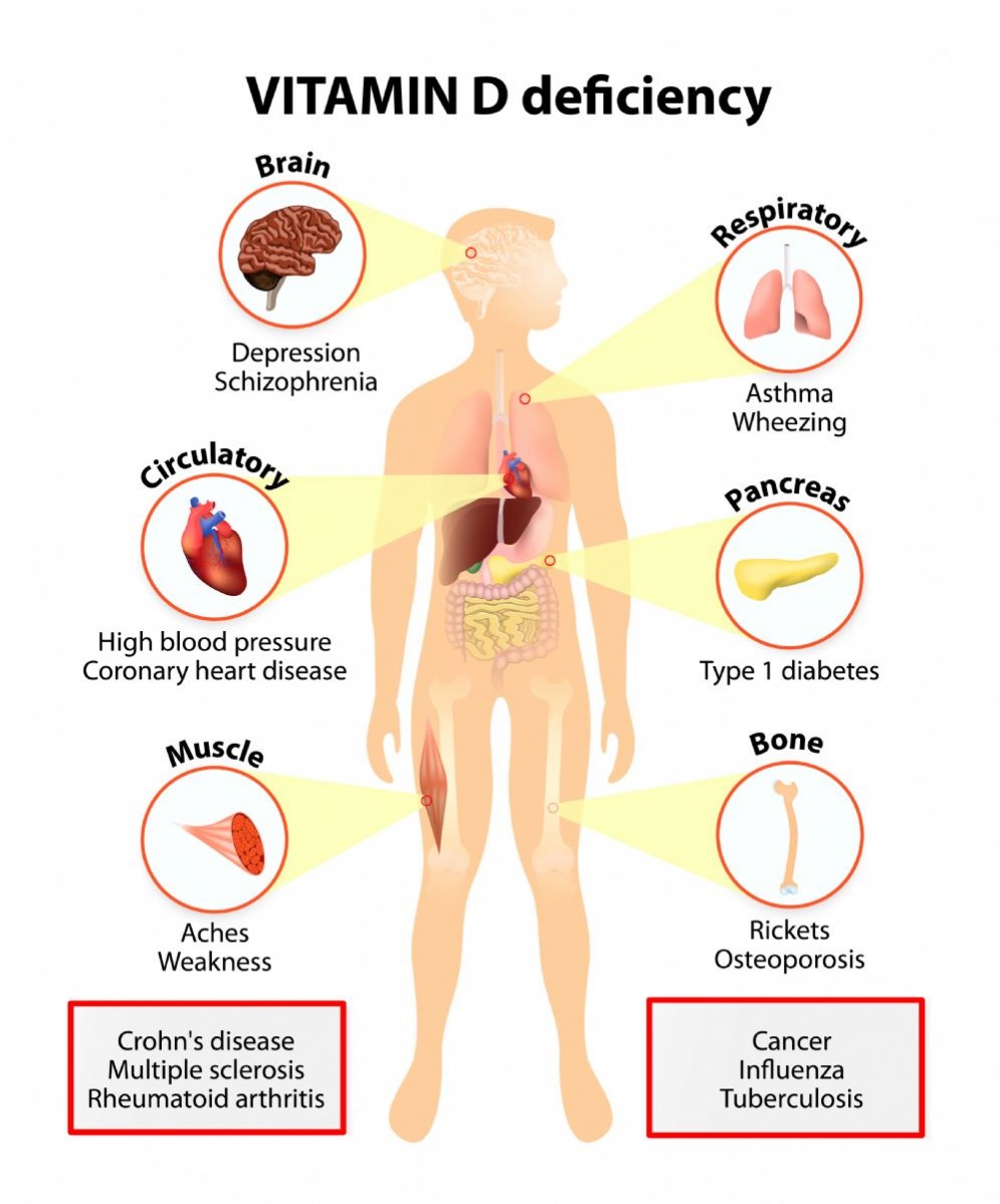 I sintomi di una carenza di vitamina D