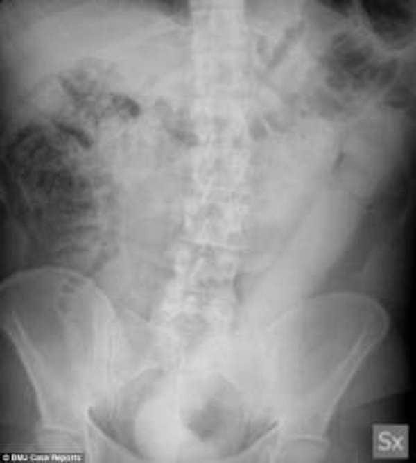 La radiografia che evidenzia il dildo infilato nell'addome
